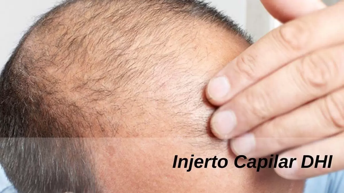 Injerto Capilar DHI en Turquía