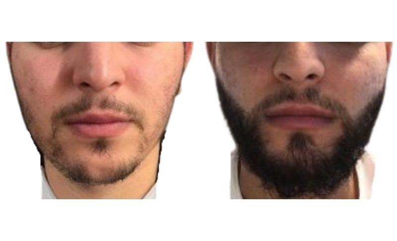 Implante De Barba Antes Y Después