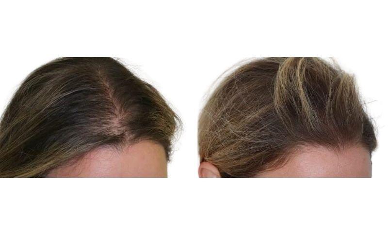 injerto de cabello en mujeres - antes y después