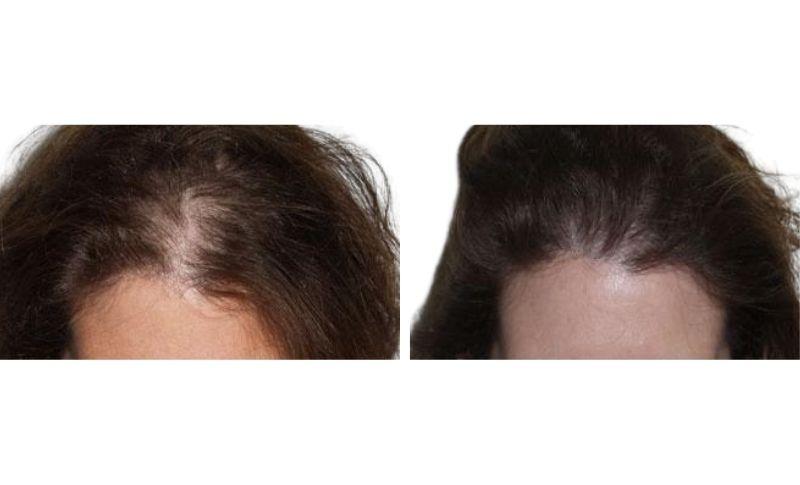 injerto de pelo en turquia para mujeres - antes y después