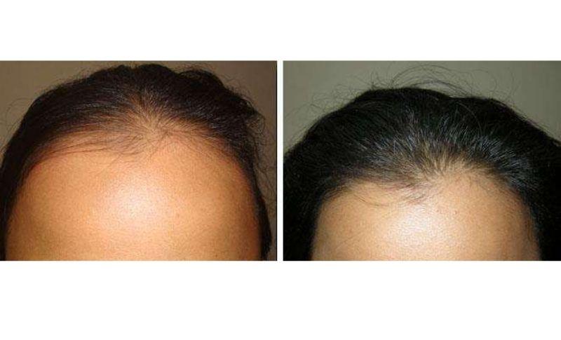 injerto de pelo para mujeres - antes y después