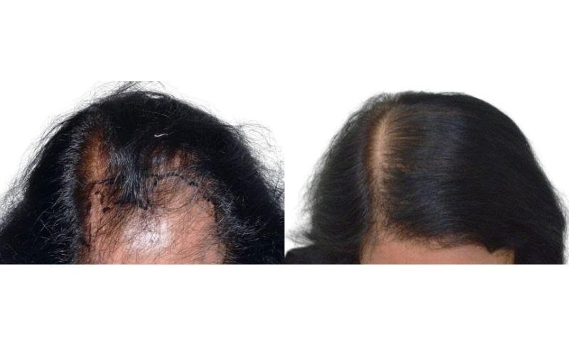 injertos de cabello para mujeres - antes y después