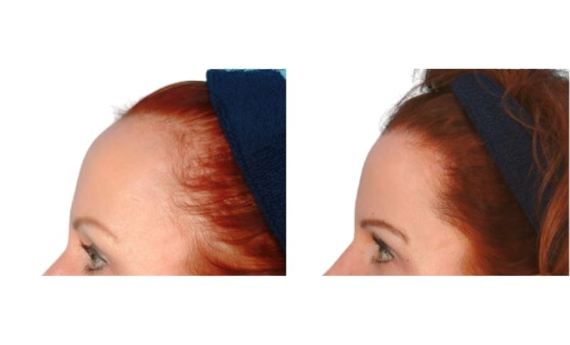 mujeres con injerto de pelo - antes y después