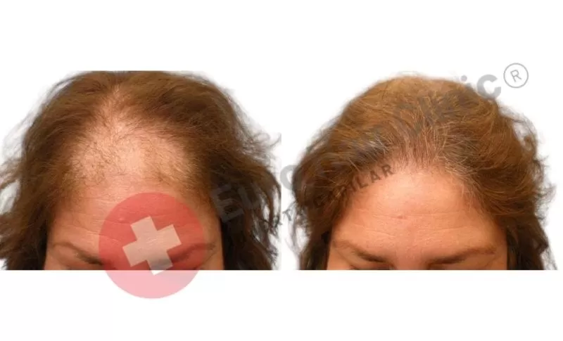 trasplante de pelos con la tecnica dhi