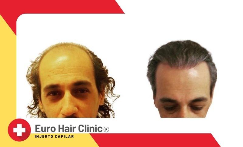 Opiniones acerca del implante de pelo en Turquía