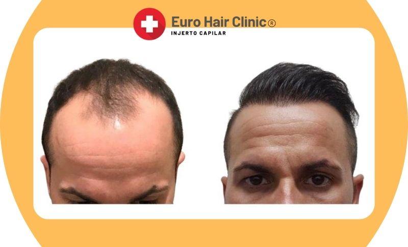 Precio implantación de pelo en Turquía