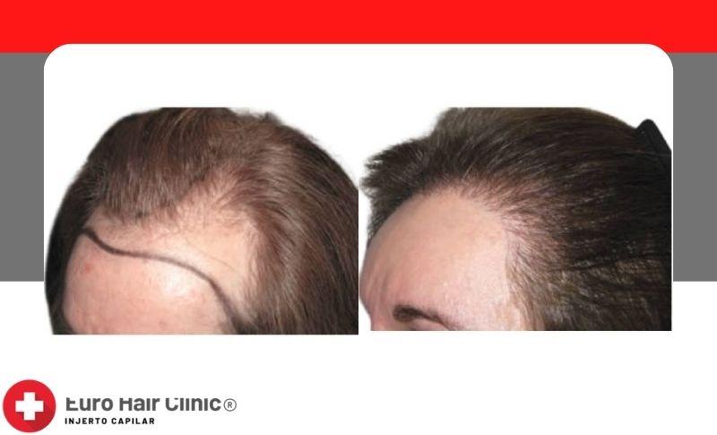 ¿Cuándo es recomendable hacer trasplante de pelo con la técnica DHI?