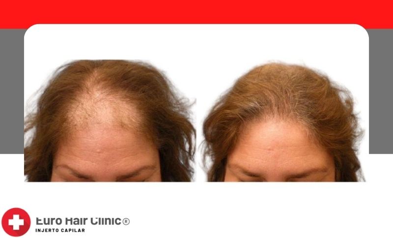 ¿Cuánto cuesta realizar el trasplante de pelo con la técnica DHI?