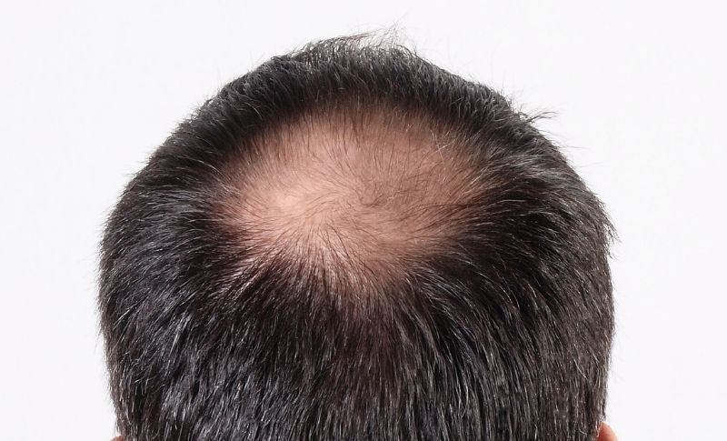 Como evitar la caída del cabello de forma natural