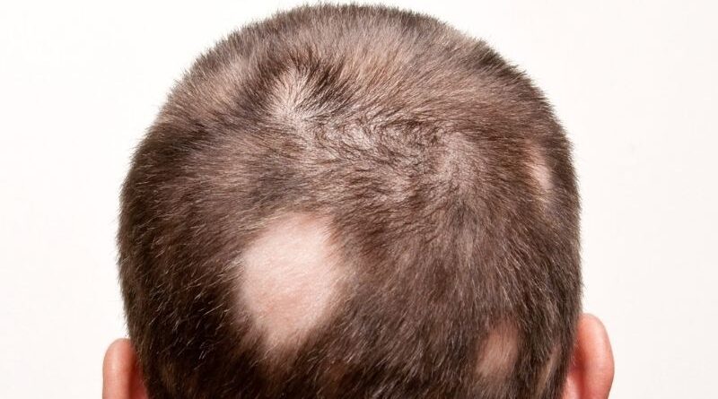 Tipos de alopecia areata