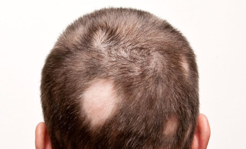 Tipos de alopecia areata
