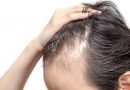 Alopecia Androgenética