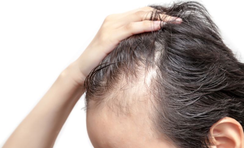Alopecia Androgenética