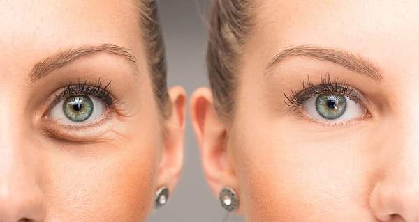 Botox y Tratamientos Estéticos: Uso Correcto y Resultados