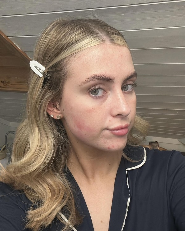 Aplicación Incorrecta en la Estética Facial: La Experiencia de Microneedling de Melia