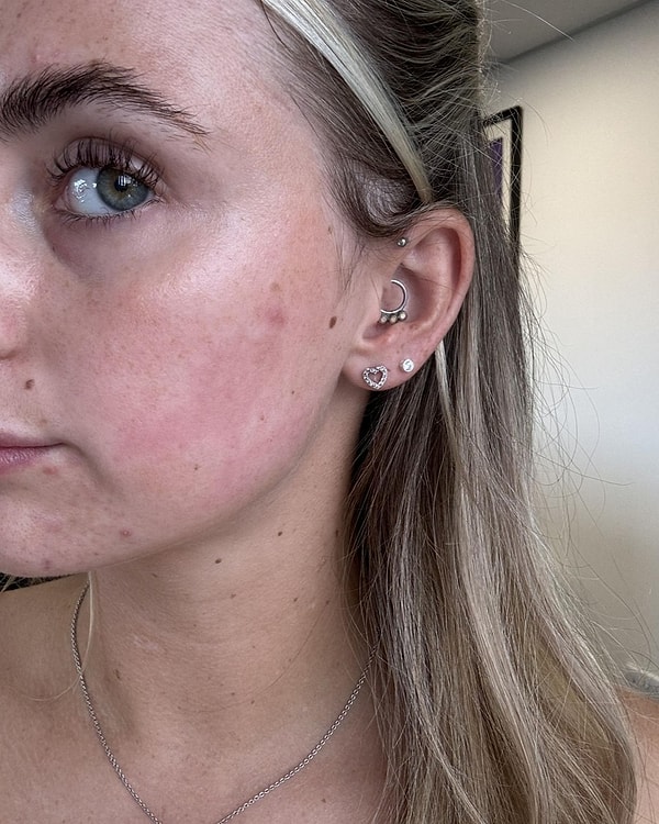 La Experiencia de Microneedling de Melia: Riesgos de las Operaciones Estéticas