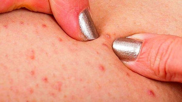 Factores que Contribuyen a la Formación de Piernas de Fresa