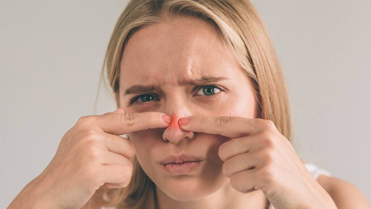 Acné y Razones por las que No Debe Exprimirse